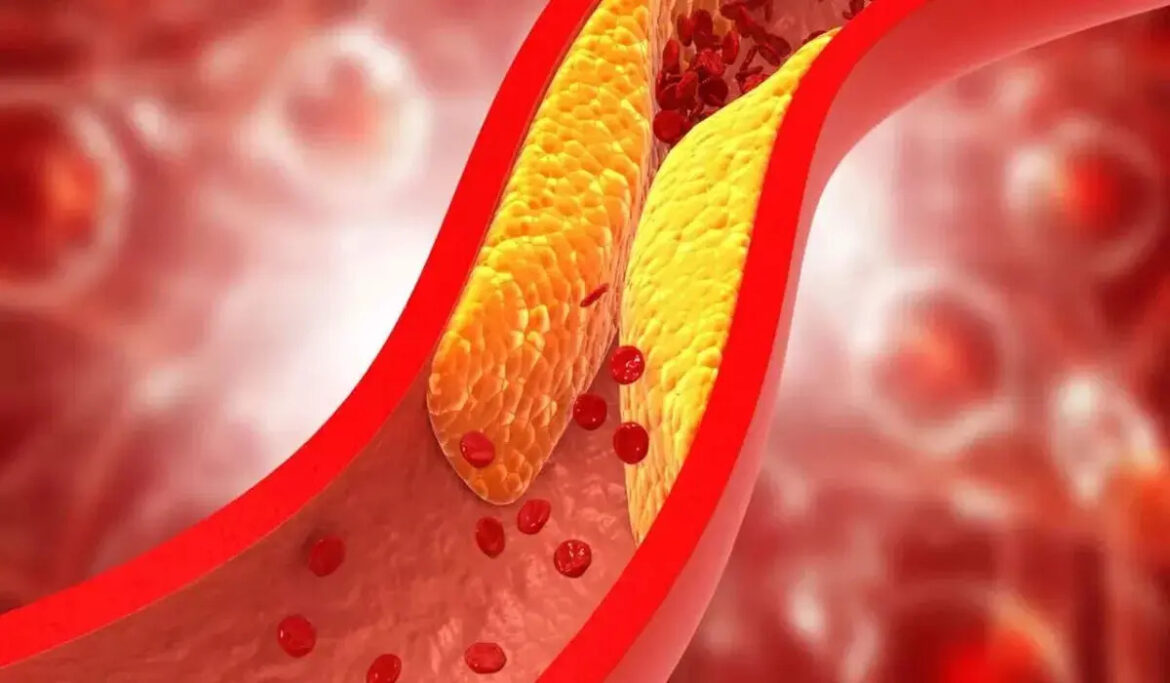 बैड कोलेस्ट्रॉल बढ़ने के ये हैं मुख्य कारण, Triglycerides कम करने के आसान तरीके बैड कोलेस्ट्रॉल बढ़ने के ये हैं मुख्य कारण, Triglycerides कम करने के आसान तरीके