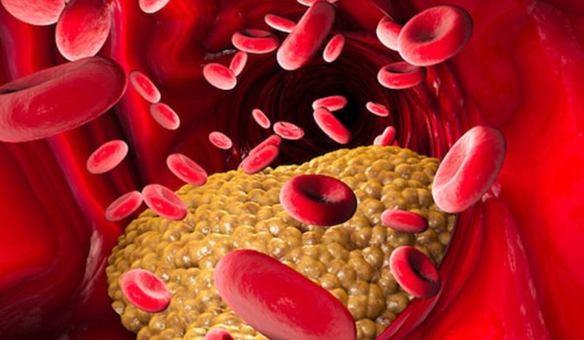 बैड कोलेस्ट्रॉल बढ़ने के ये हैं मुख्य कारण, Triglycerides कम करने के आसान तरीके