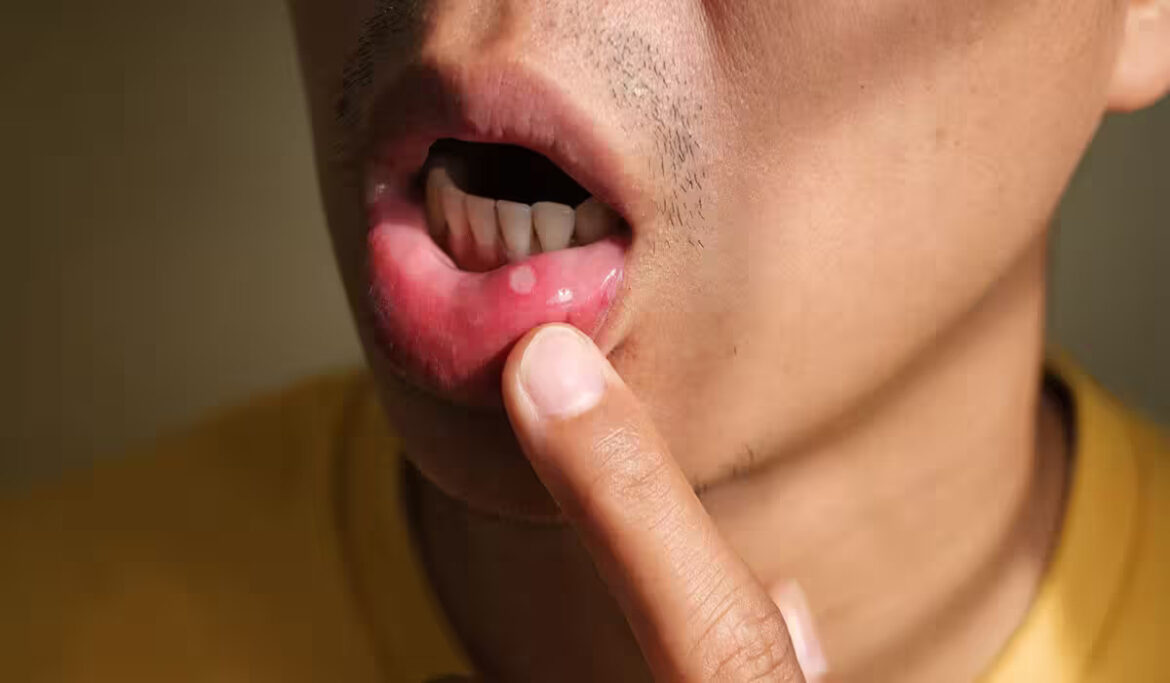 Mouth Ulcers: यदि होते हैं बार-बार तो ध्यान रखें, ये संकेत हो सकते हैं गंभीर बीमारियों के Mouth Ulcers: यदि होते हैं बार-बार तो ध्यान रखें, ये संकेत हो सकते हैं गंभीर बीमारियों के