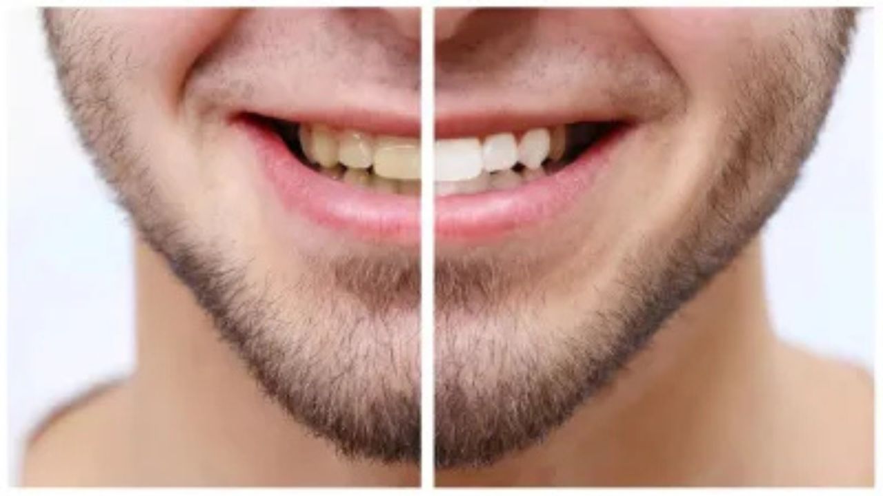 World Oral Health Day: दांतों की सफेदी के लिए रोज़ाना अपनाएं ये ओरल केयर टिप्स